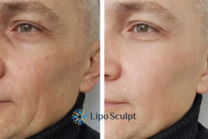 How to Fight Aging Symptoms 3 Fight Aging Symptoms Reading With HIFU and Morpheus8 Today!