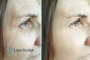 How to Fight Aging Symptoms 2 Do you want to Fight Aging Symptoms Reading? Contact Lipo Sculpt today!