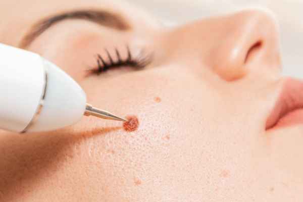 CryoPen: 5 Skin Concerns It May Be Used to Treat 3 What actually happens during a CryoPen treatment Reading?
